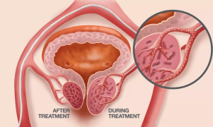 What is the latest treatment for enlarged prostate