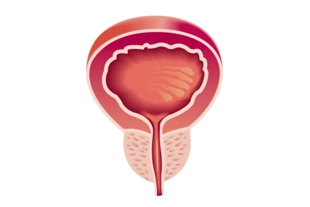 هل يمكن الشفاء من تضخم البروستاتا