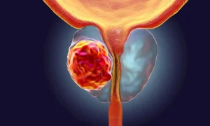 Amelioration of survival outcome after early prostatectomy