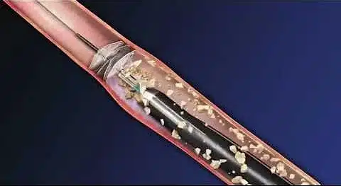 تمر حصوات الحالب الصغيرة التي يقل قطرها عن 5 ملليمترات عبر المسالك البولية