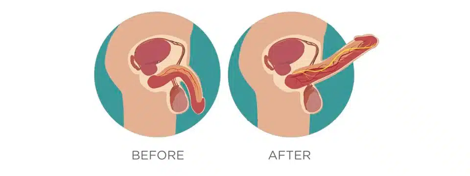 ما هي مدة علاج الضعف الجنسي؟ ومتي تظهر نتيجة العلاج؟