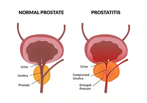 هل التهاب البروستاتا يزول بدون علاج